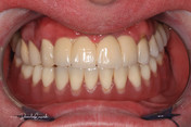 Proteza zębowa Lokator przed i po zabiegu