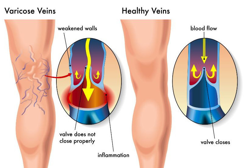 Problem z żylakami na nogach