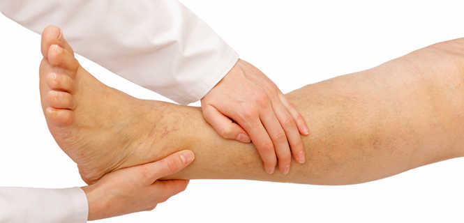Jak dbać o nogę po operacji żylaków?