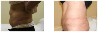 Chirurgia plastyczna ciała i modelowanie sylwetki przed i po zabiegu