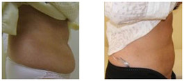 Liposukcja klasyczna SAL przed i po zabiegu