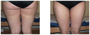 Liposukcja klasyczna SAL przed i po zabiegu