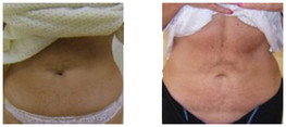 Liposukcja - odsysanie tłuszczu przed i po zabiegu