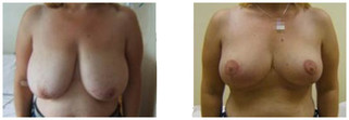 Operacje plastyczne piersi przed i po zabiegu