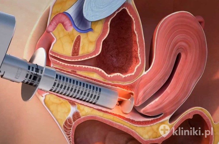 Zabieg laserowe leczenia nietrzymania moczu - rysunek poglądowy