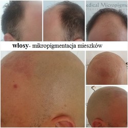 Zabiegi mikropigmentacji włosów przed i po zabiegu