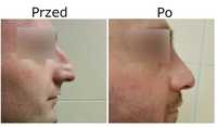 Operacje plastyczne nosa przed i po zabiegu