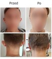 Operacje plastyczne uszu przed i po zabiegu
