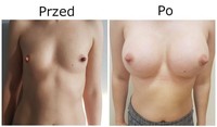 Powiększanie piersi przed i po zabiegu