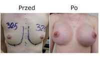Powiększanie piersi przed i po zabiegu