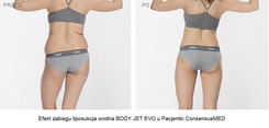 Liposukcja wodna Body Jet WAL przed i po zabiegu