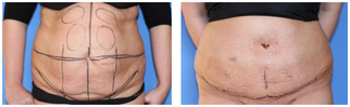 Chirurgia plastyczna ciała i modelowanie sylwetki przed i po zabiegu