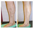 Laserowe leczenie żylaków nóg przed i po zabiegu