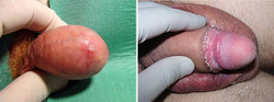 Chirurgiczne leczenie stulejki - zdjęcia przed i po zabiegu
