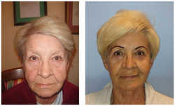 Lifting operacyjny przed i po zabiegu