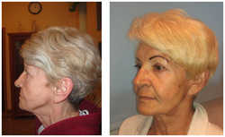 Lifting operacyjny przed i po zabiegu