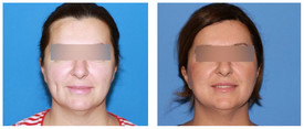 Lifting operacyjny twarzy i szyi przed i po zabiegu