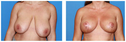 Operacje plastyczne piersi przed i po zabiegu