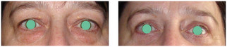 Operacje plastyczne powiek przed i po zabiegu