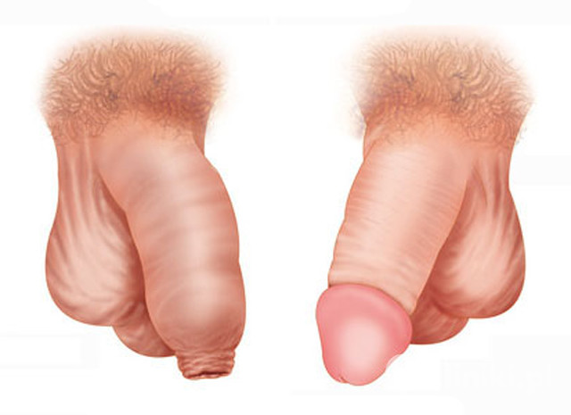 Penis przed i po obrzezaniu - rysunek poglądowy