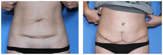 Plastyka ciała (body lifting) przed i po zabiegu