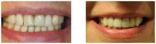 Protetyka stomatologiczna przed i po zabiegu