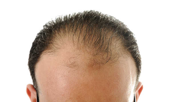 Przeszczep włosów metodą S.A.F.E.R.
