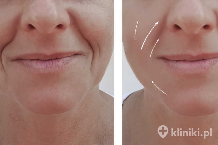 Usuwanie zmarszczek preparatem Juvederm - zdjęcia przed i po zabiegu