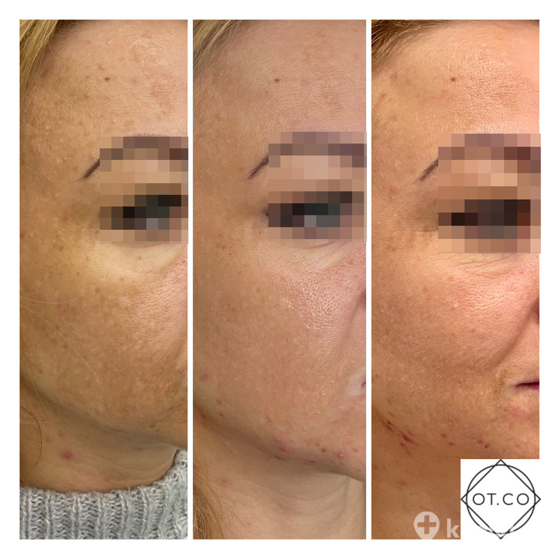 Laserowe usuwanie przebarwień skóry zdjęcia przed i po Kliniki.pl