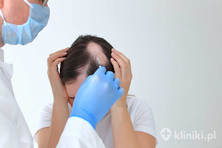 Skuteczne leczenie łysienia plackowatego wymaga indywidualnego podejścia, cierpliwości oraz regularnych kontroli dermatologicznych