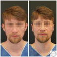 Operacje plastyczne uszu przed i po zabiegu