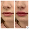 Powiększanie ust kwasem hialuronowym przed i po zabiegu