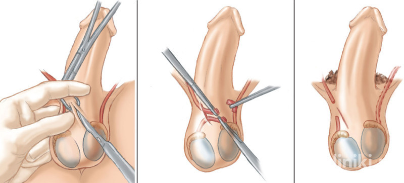Przebieg zabiegu wazektomii - rysunek poglądowy