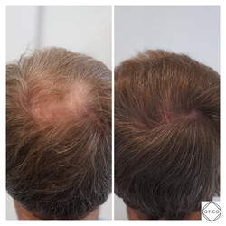 Zabiegi przeszczepiania włosów przed i po zabiegu