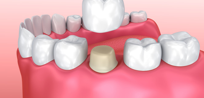 Korony na implantach