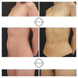 Liposukcja brzucha przed i po zabiegu