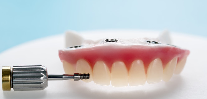 Proteza zębowa stabilizowana na 2 implantach