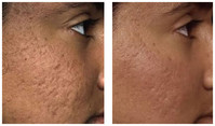 Blizny potrądzikowe na całej twarzy - usuwanie laserem przed i po zabiegu