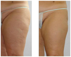 Laserowe usuwanie cellulitu przed i po zabiegu