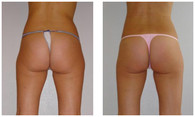 Laserowe usuwanie cellulitu przed i po zabiegu