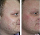 Laserowe usuwanie zmian skórnych przed i po zabiegu