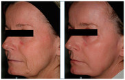 Lifting laserowy, usuwanie zwiotczenia skóry przed i po zabiegu