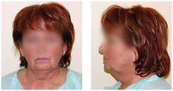 Lifting operacyjny przed i po zabiegu