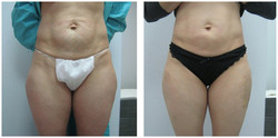 Lipoliza laserowa - usuwanie tkanki tłuszczowej przed i po zabiegu