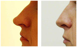 Operacje plastyczne nosa przed i po zabiegu