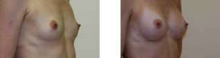 Operacje plastyczne piersi przed i po zabiegu