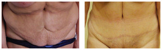 Plastyka ciała (body lifting) przed i po zabiegu