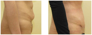 Plastyka ciała (body lifting) przed i po zabiegu