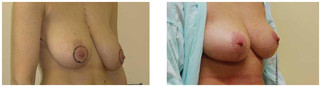 Podniesienie piersi z pomniejszeniem przed i po zabiegu