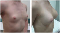 Powiększanie piersi implantami przed i po zabiegu